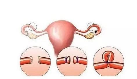 输卵管性不孕